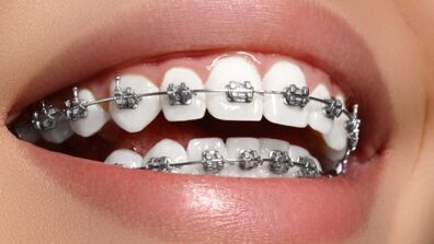 Adult Braces