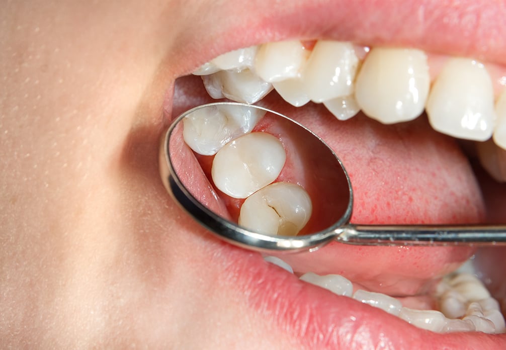 Dental Fillings