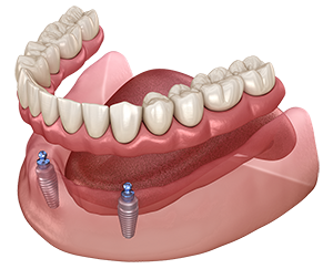 Implant supported denture